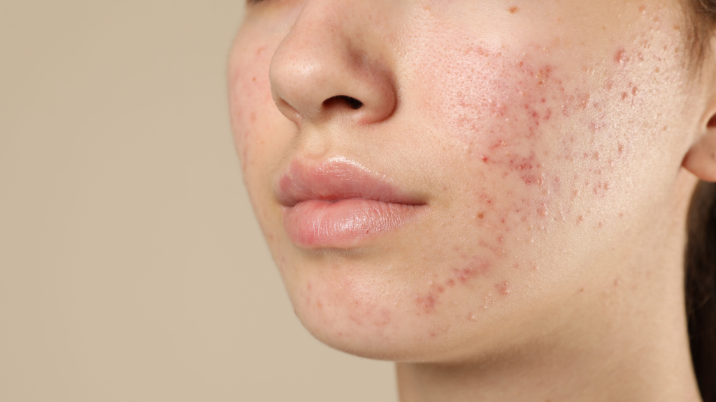 Akne Bakımı | Görsel: Canva