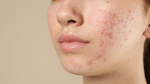 Akne Bakımı | Görsel: Canva