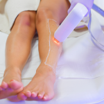 Lazer Epilasyon | Görsel: Canva