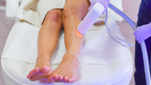 Lazer Epilasyon | Görsel: Canva