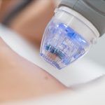 Mikroiğneleme (Dermapen)