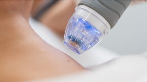 Mikroiğneleme (Dermapen)